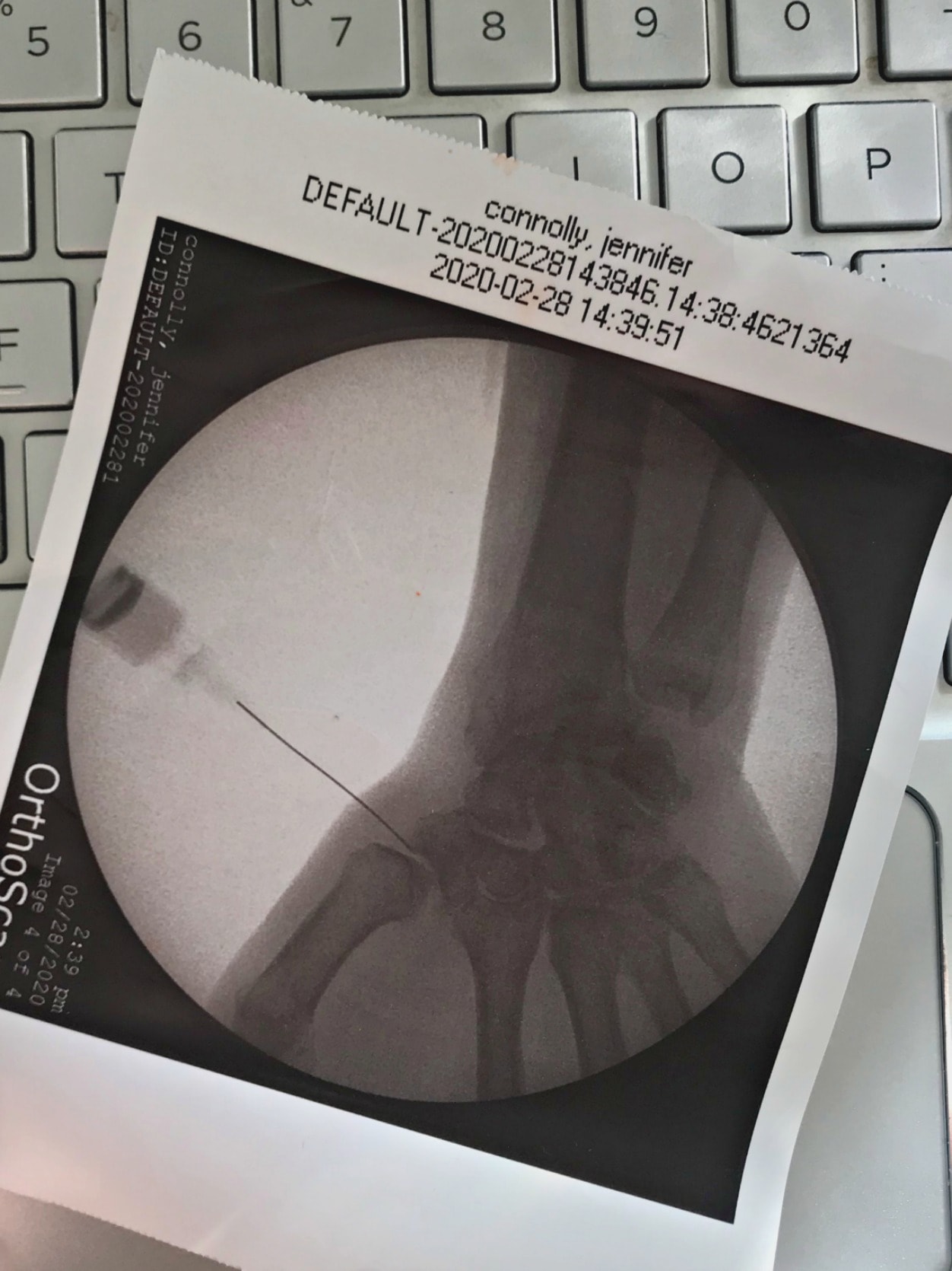 hand xray of cortisone shot