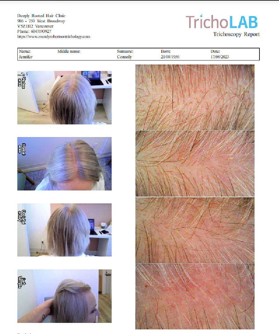 IMAGES FROM TRICHOSCOPY REPORT ON SHOWING REASONS FOR THINNING HAIR IN WOMAN OVER 50